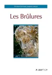 Les brûlures